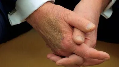 گمانهزنی ها در مورد علت کبودی دست دونالد ترامپ گمانهزنی ها در مورد علت کبودی دست دونالد ترامپ