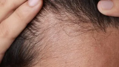 «دیاچتی» چه نقشی در ریزش مو دارد و چگونه میتوان آن را مهار کرد؟ «دیاچتی» چه نقشی در ریزش مو دارد و چگونه میتوان آن را مهار کرد؟